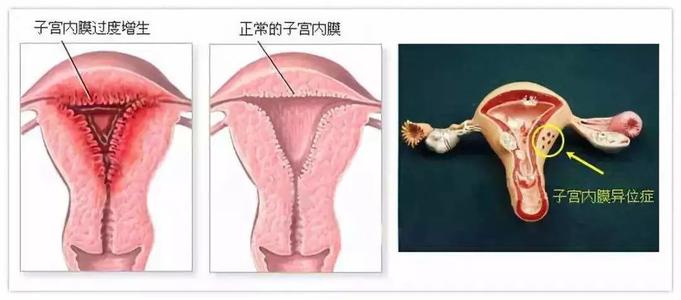 孕道试管：子宫内膜的薄厚对受孕影响这么大？