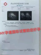 恭喜江苏的Z哥夫妇的YMM一次植移‬两个Y囊成胚‬功双胎