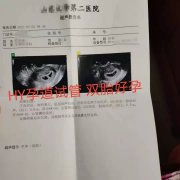 孕道试管：恭喜失独Z姐停经后双胎好孕