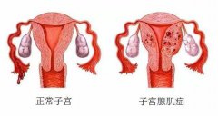 孕道国际为您解读：子宫腺肌症如何检查