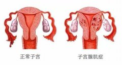孕道国际为您解读：子宫腺肌症如何检查